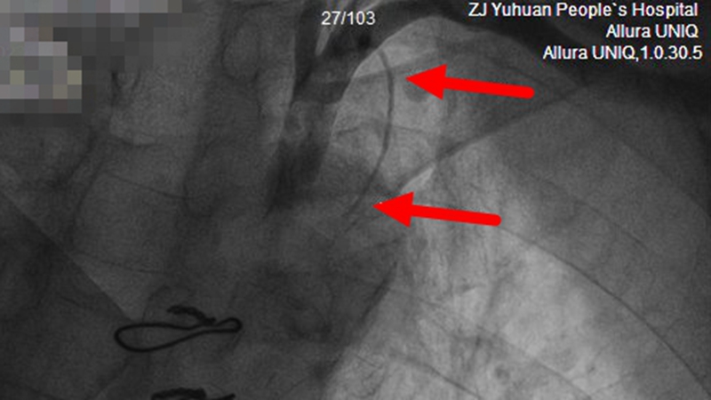 C:\Users\admin\Desktop\20230410心內(nèi)科搭橋搶救\王熙平 冠脈手術(shù)截圖 左側(cè)內(nèi)乳動脈纖細 遠端完全閉塞.jpg