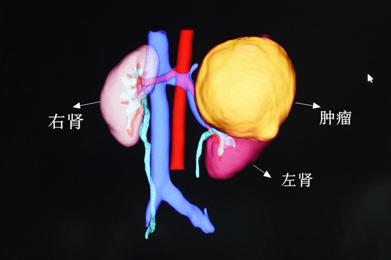 C:\Users\admin\Desktop\20230522泌尿外科10歲女童左腎長巨大腫瘤，宛如第三個腎臟\DSC06254.JPG